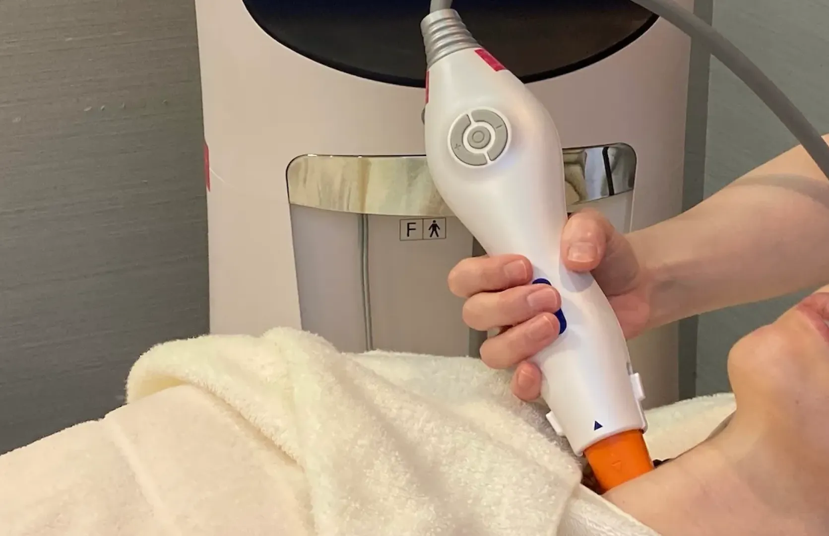 頬と口角の位置が速攻引き上がる ! 即効性があり施術直後でも効果を実感できます