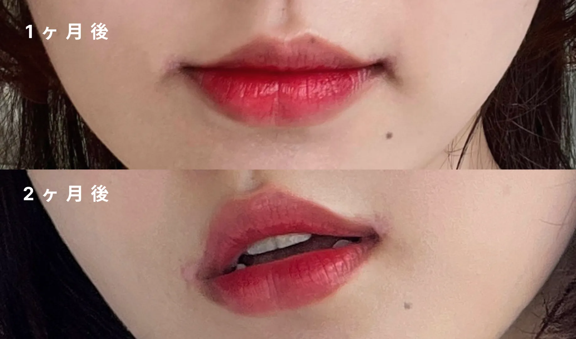 想像以上の傷跡にびっくり…メイクをしてもやっぱり目立つ